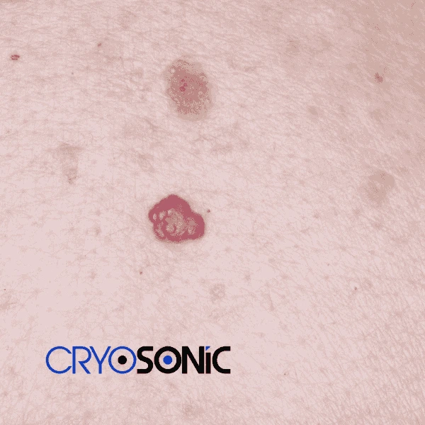 Looking for pain free cherry angioma removal treatment Scarborough? Call our team today! Scarborough
