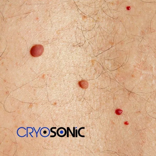 get cherry angioma removal treatment today! Scarborough