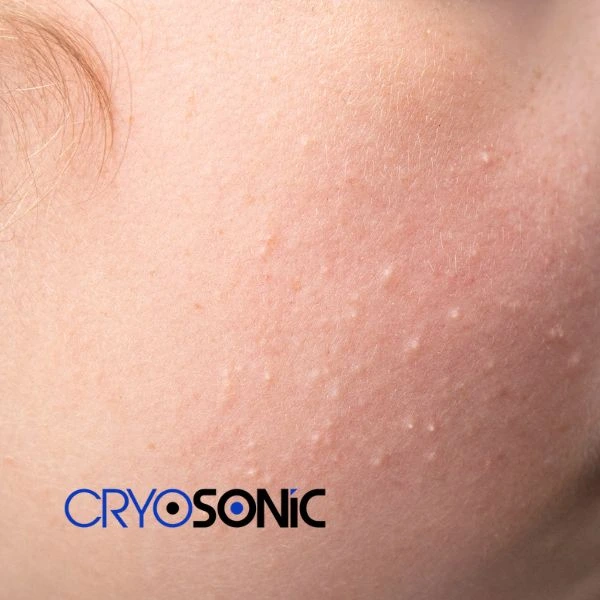 Are you looking for milia removal treatment? Contact our team today Scarborough
