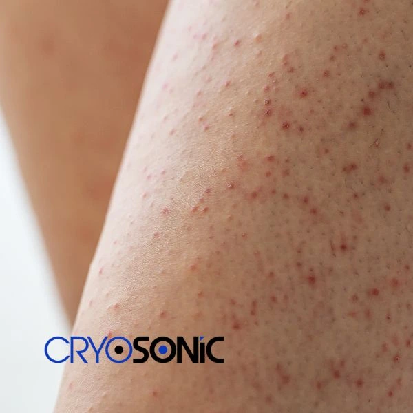 Looking for Seborrhoeic Keratosis removal Scarborough treatment? Call our consultants today in Scarborough