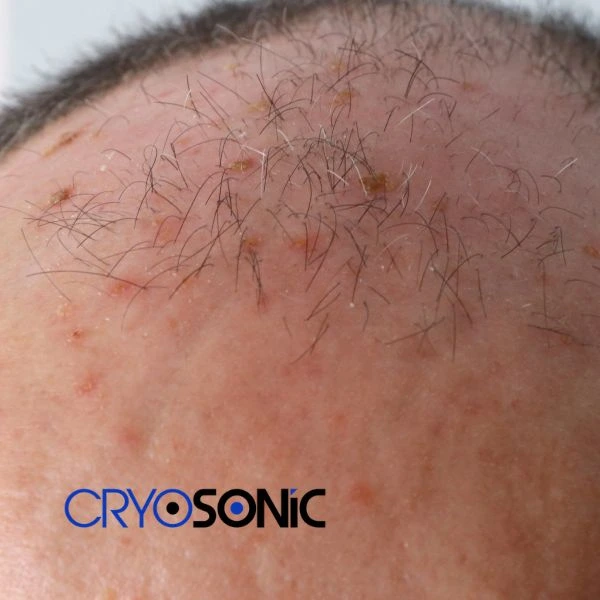 Access Seborrhoeic Keratosis removal from the comfort of your own home! Call us today in Scarborough