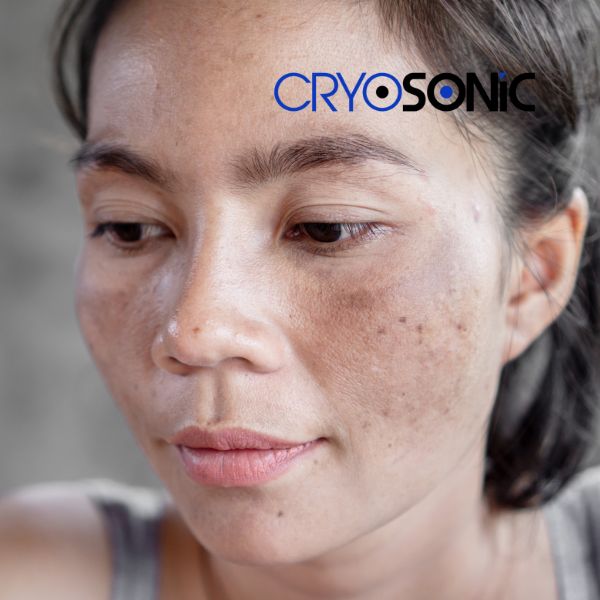 Ready to start age spots removal? Contact our team today in Scarborough