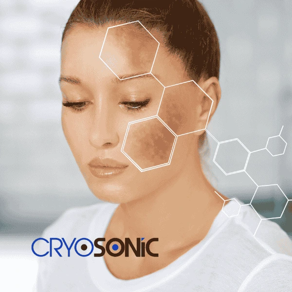 Are you looking for age spot removal treatment? Contact Cryosonic today in Scarborough