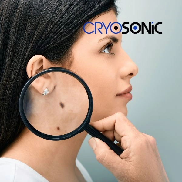 Do you want to learn more about benign moles removal treatment? Call our team today Scarborough
