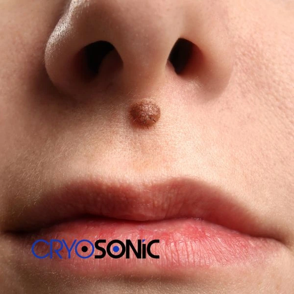 Start your benign moles removal treatment today Scarborough