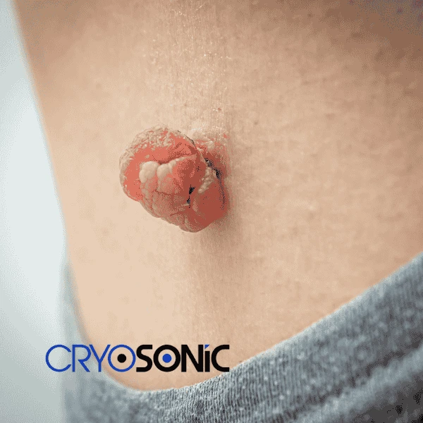 Book your skin tags removal Scarborough from comfort of your own home! Scarborough