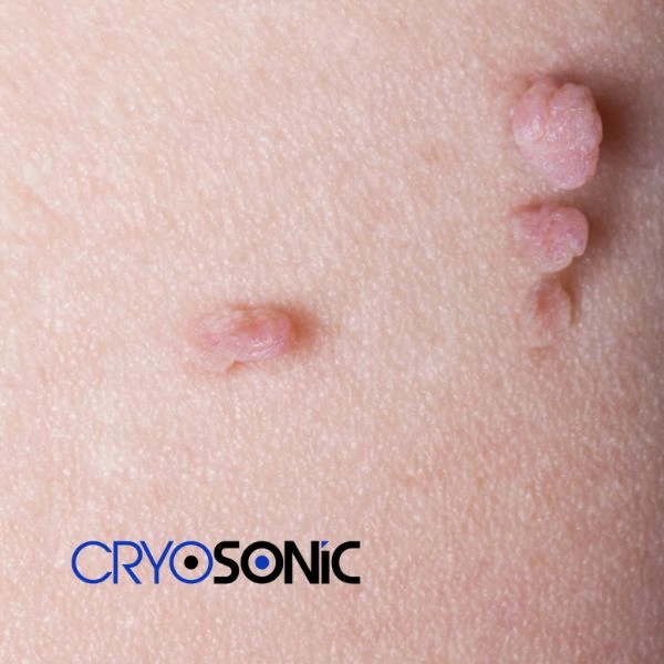 Are you looking for fast effect skin tag removal Scarborough? Book in NOW! Scarborough