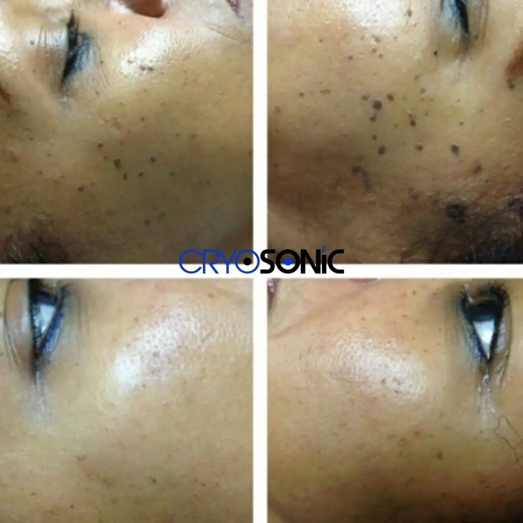 Why Skin Shows Pigmentation After Treatment Scarborough