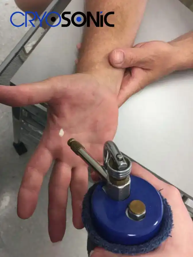 Temperature Differences: OTC vs Medical-Grade Cryotherapy Scarborough